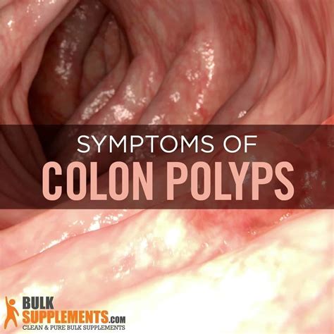 Laparoscopic primary repair is safe and feasible in resolving colonic perforation due to colonoscopy , and postoperative complications were significantly related to perforation site, preoperative medication of glucocorticoid, perforation diagnosis time, and intestinal cleanliness. . Celebrities with colon polyps